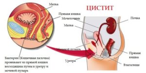 цистит у женщин